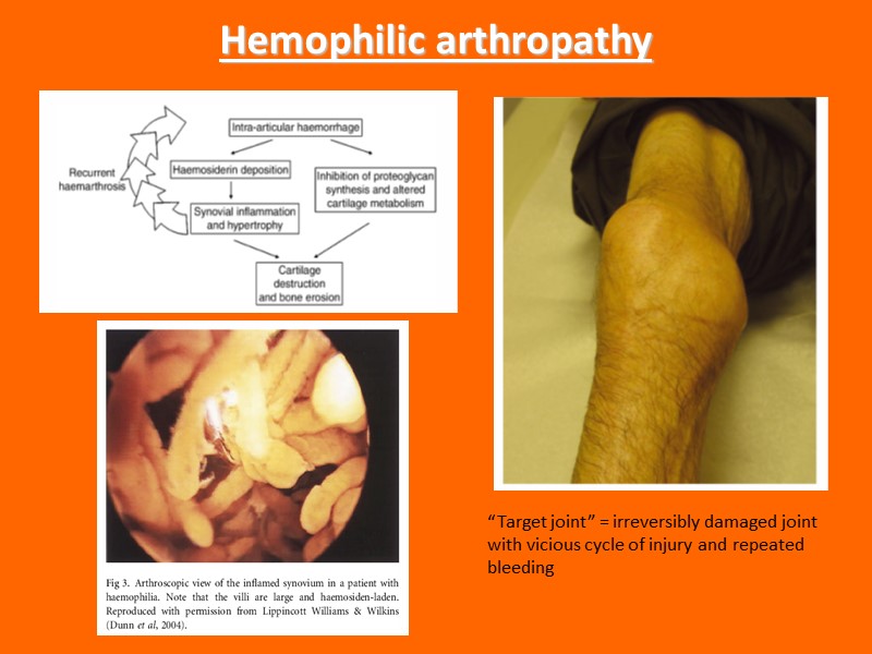 Hemophilic arthropathy “Target joint” = irreversibly damaged joint with vicious cycle of injury and